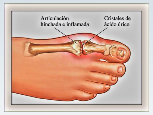 acido urico