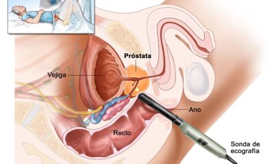 cancer prostata