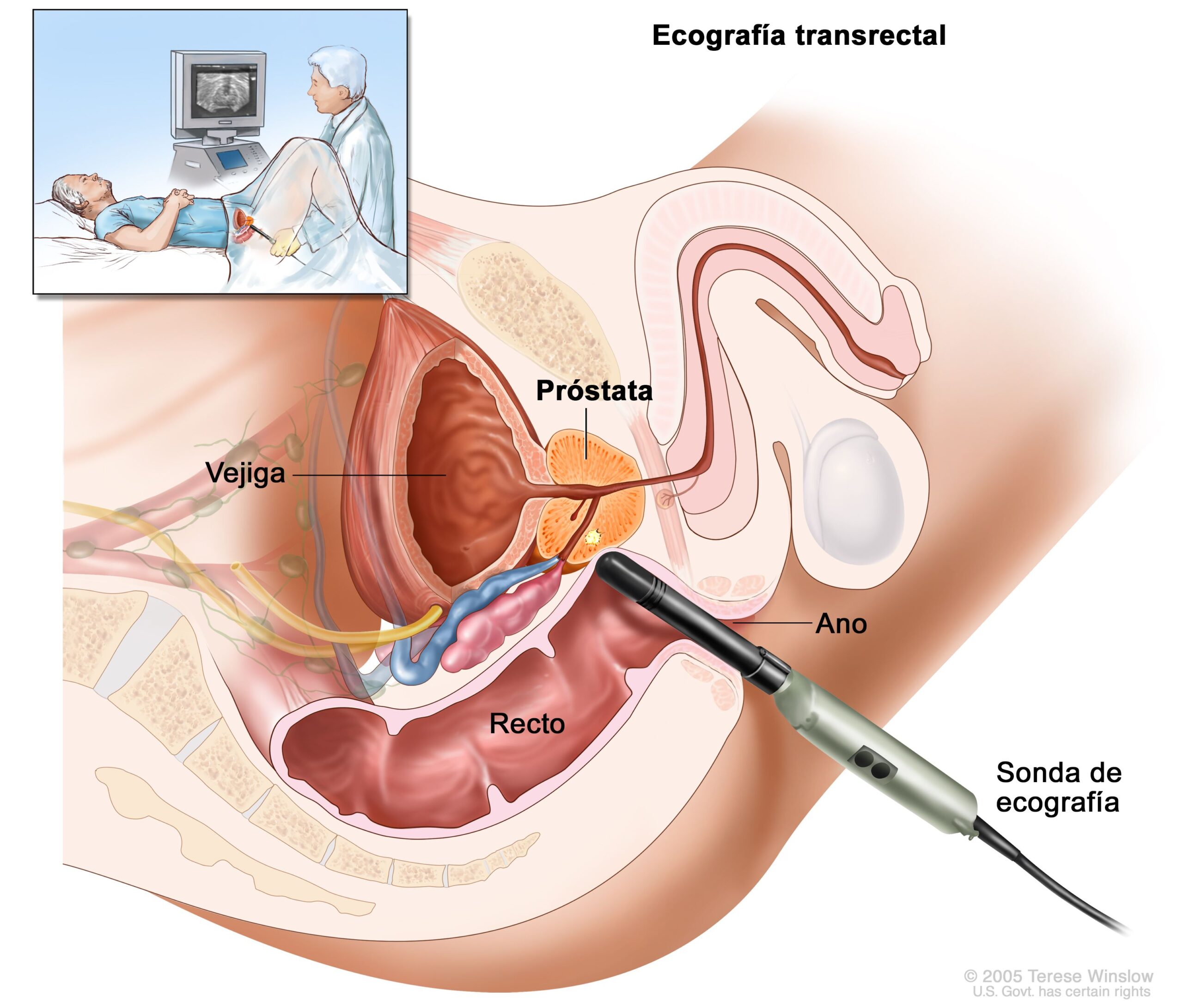 cancer prostata