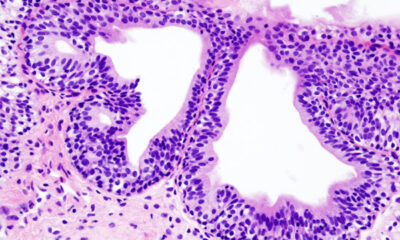 cistitis infecciosa