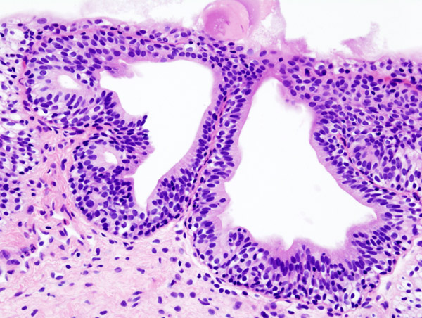 cistitis infecciosa