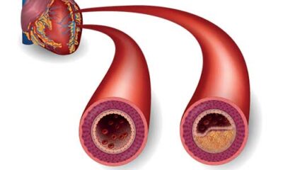 colesterol hdl