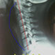 contractura cervical