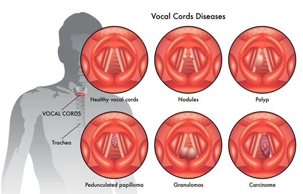 cuerdas vocales