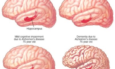 deterioro cognitivo