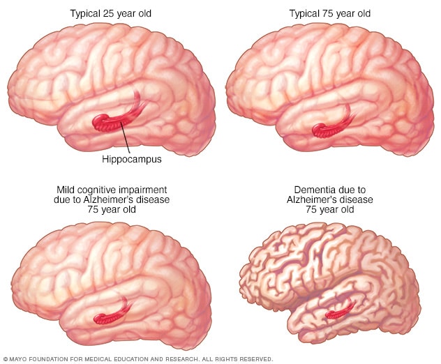 deterioro cognitivo