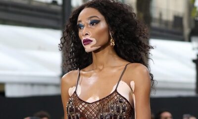 el vitiligo