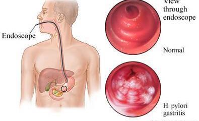 gastritis erosiva