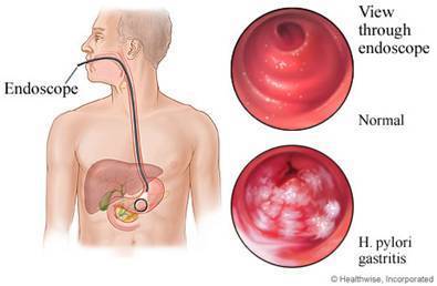 gastritis erosiva