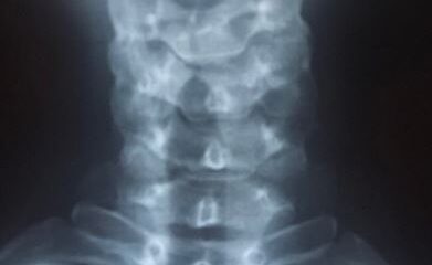 hernia discal