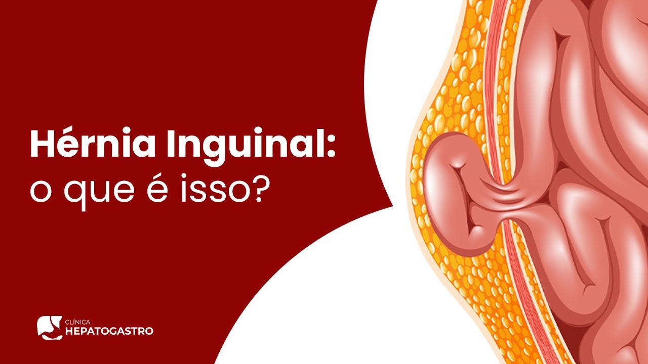 hernia inguinal