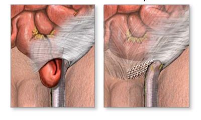 hernia inguinal