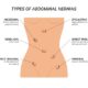 hernias abdominales