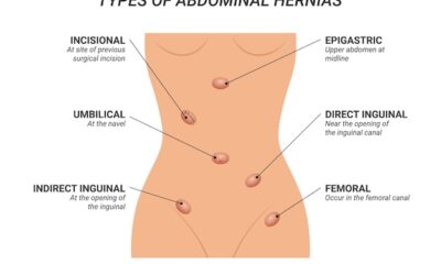 hernias abdominales