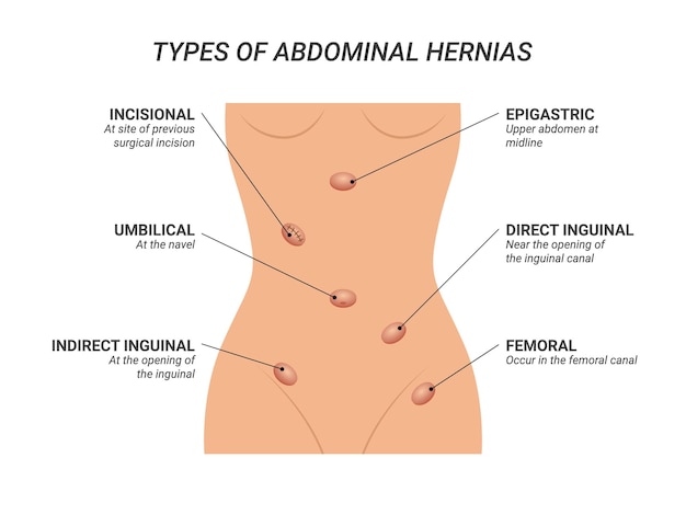 hernias abdominales