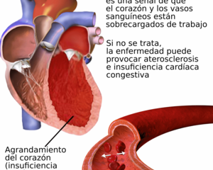 hipertension arterial