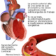 hipertension arterial