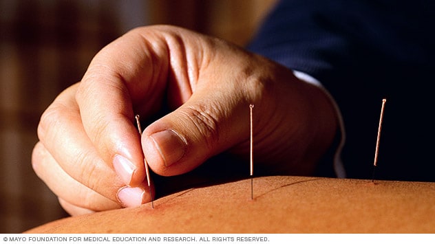 la acupuntura