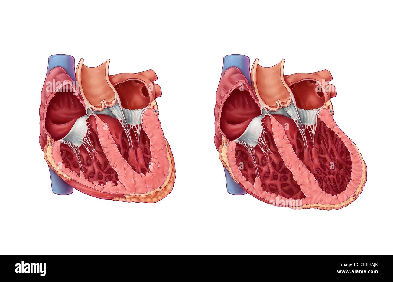 miocardiopatia dilatada