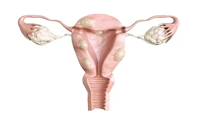 miomas uterinos