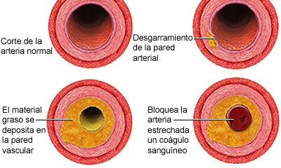 niveles colesterol