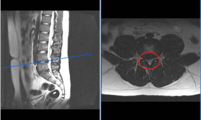 protusion discal