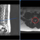 protusion discal