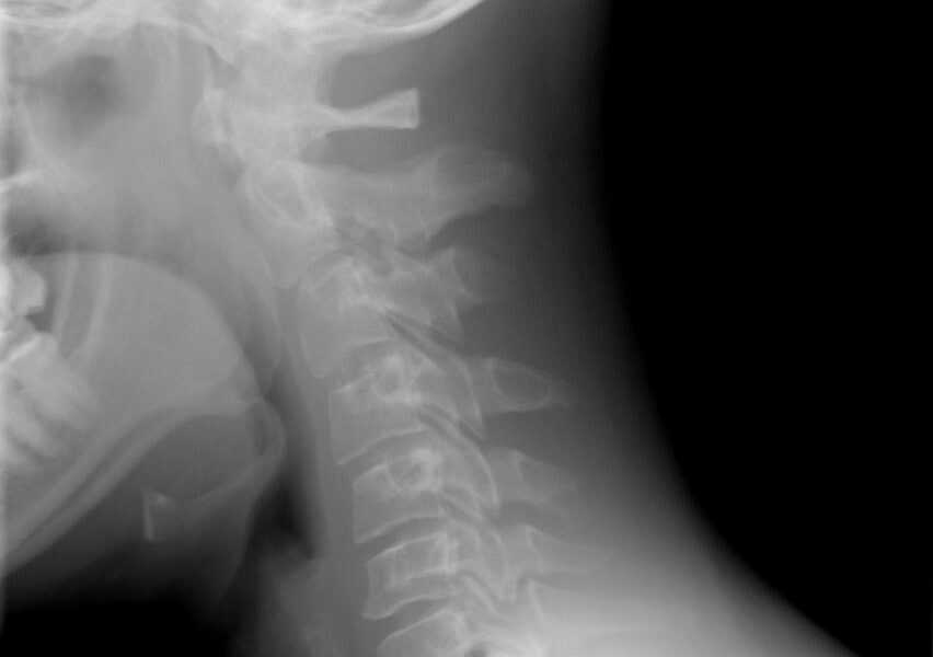 Rectificación de la lordosis cervical Cómo mejorar la postura y prevenir el dolor de cuello Rectificación de la lordosis cervical Cómo mejorar la postura y prevenir el dolor de cuello