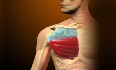 tendinitis pectoral