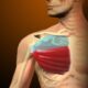 tendinitis pectoral