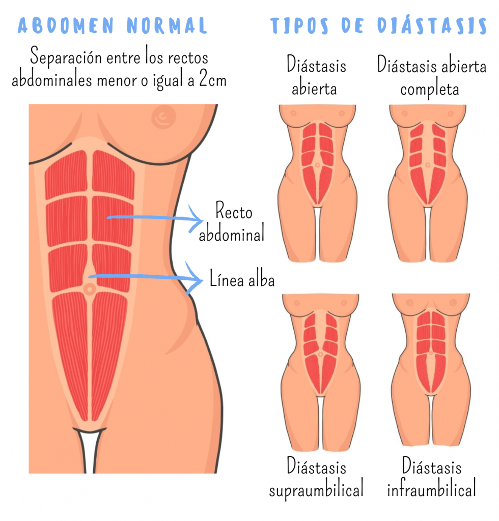 tipos abdomen