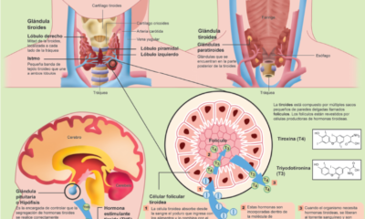 tiroiditis hashimoto